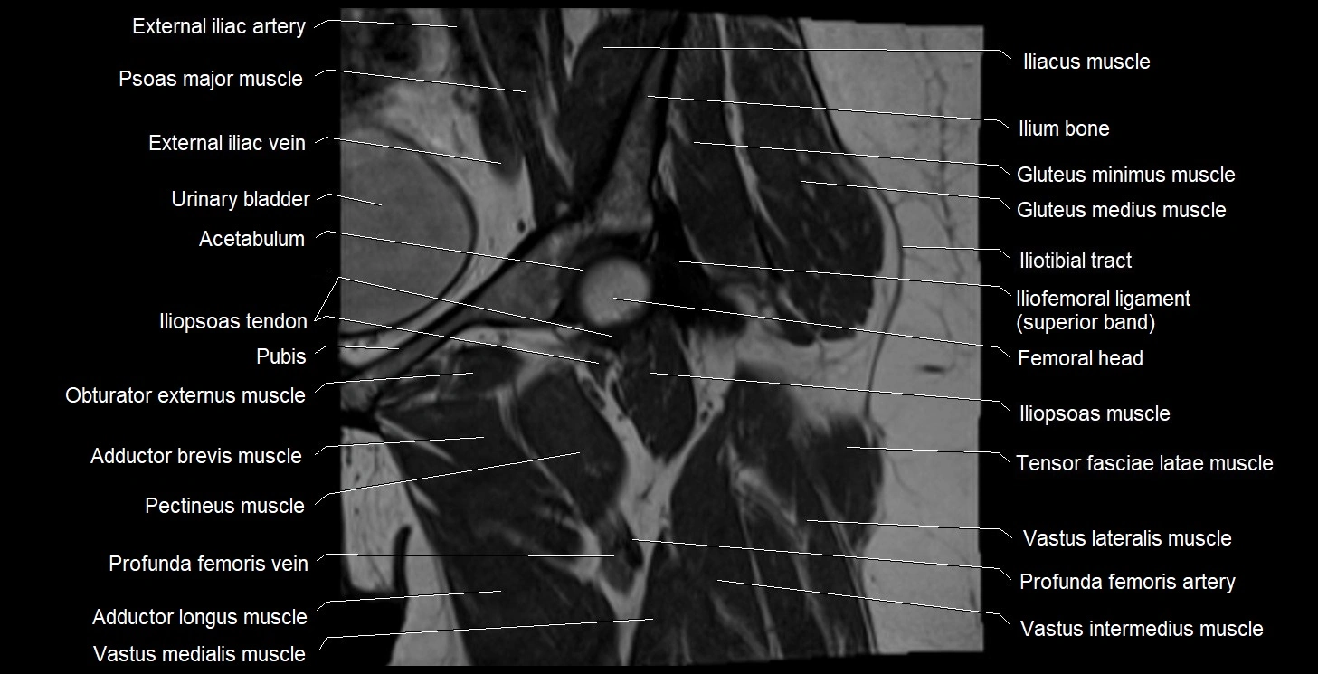 MRI Hip 3T coronal cross sectional anatomy image 22.webp